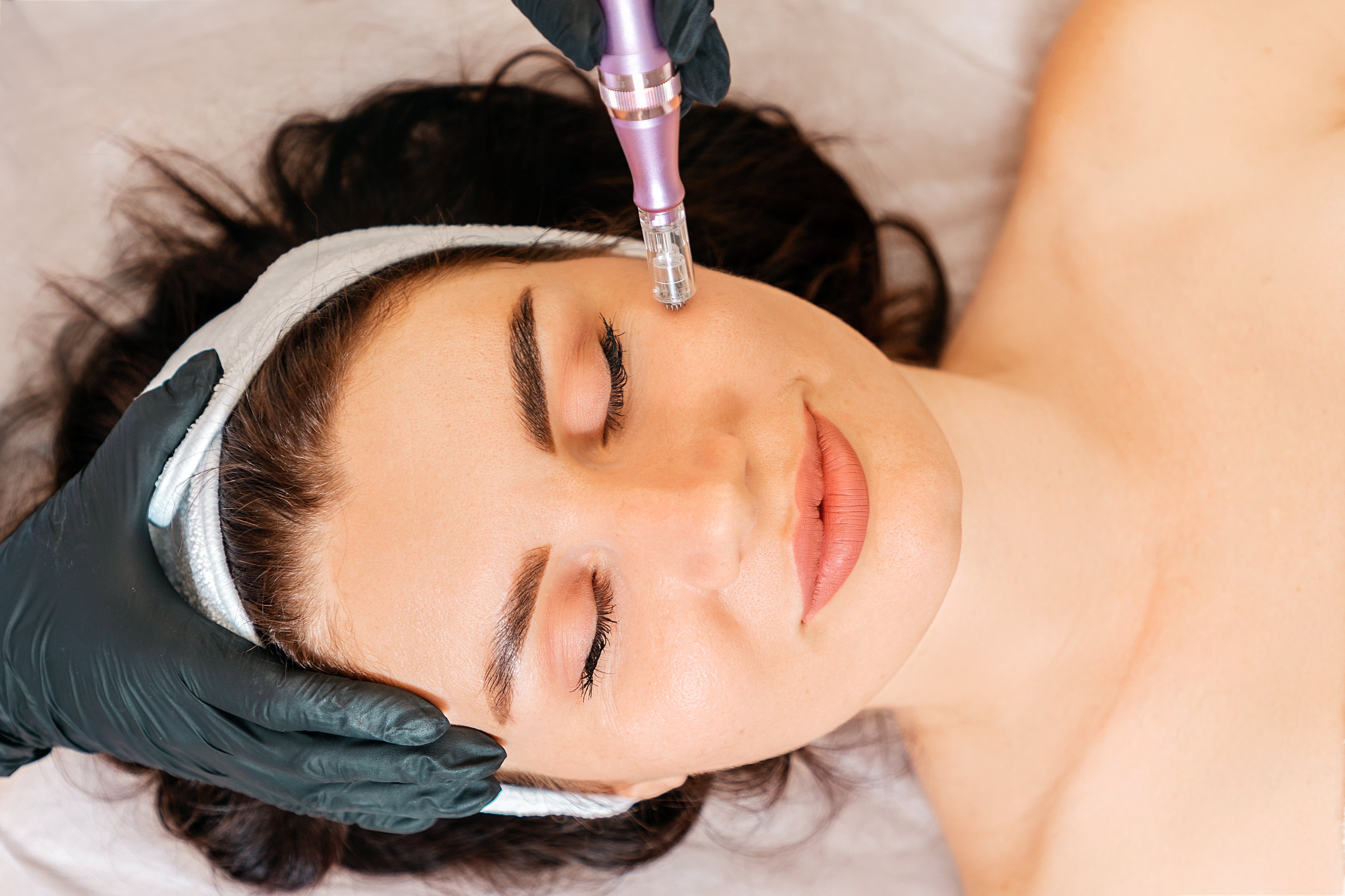 Refreshed healthy-looking skin after microneedling